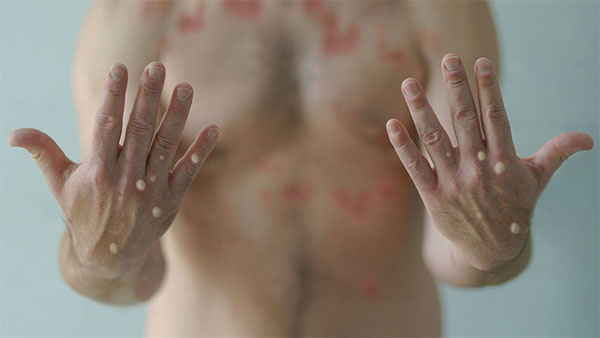 ශ්‍රී ලංකාවෙනුත් මන්කි ෆොක්ස් රෝගියෙක්