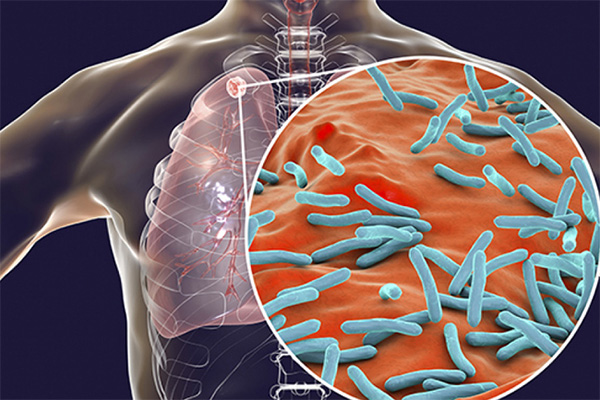 ක්ෂය රෝගය පිළිබඳව WHO හෙළිදරව්වක්